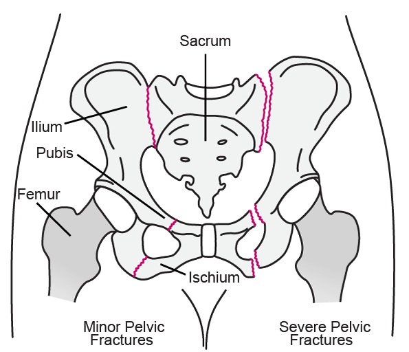 File:Pelvic fracture illustration.jpg