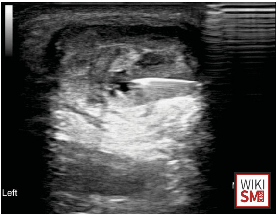 File:Achilles tendon injection midbody short axis in plane US.jpg