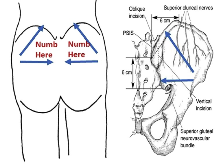 File:Target sites for anesthesia relative to the SI joint.jpg