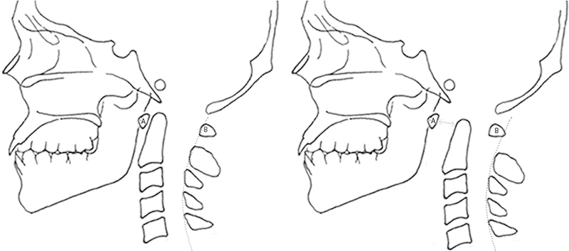 File:Atlantoaxial dislocation.jpg