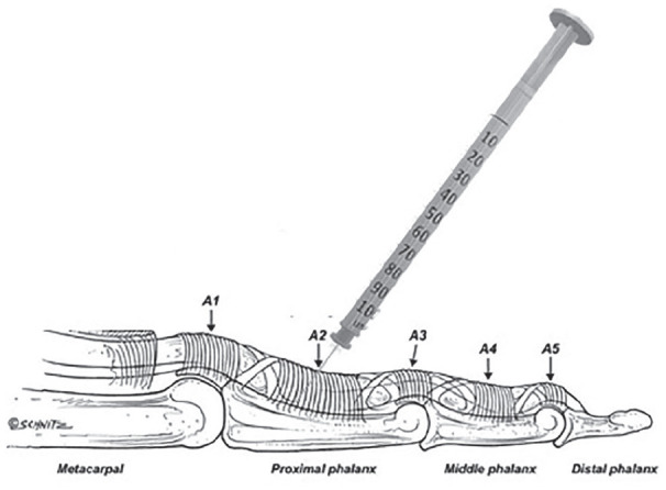 File:Trigger finger injection palpation proximal phalanx technique.jpg