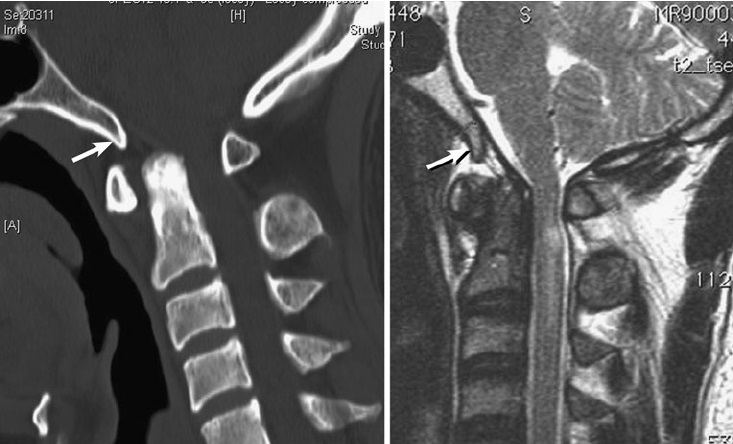 File:Third condyle.jpg