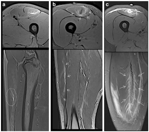 File:MRI rectus femoris muscle injury.jpg