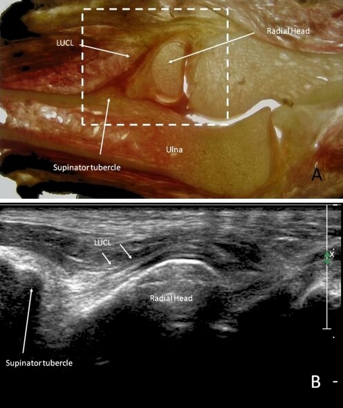 File:Ultrasound elbow LCL tear.jpg