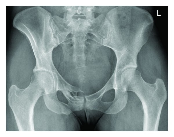 File:Chronic pelvic fracture.jpg