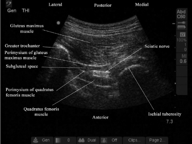 File:Transverse ultrasound between the greater trochanter and ischial tuberosity.jpg