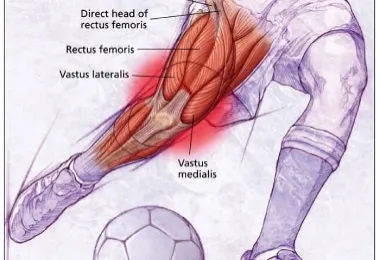 File:Rectus femoris injuries.jpg
