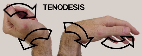File:Passive wrist tenodesis test.jpg