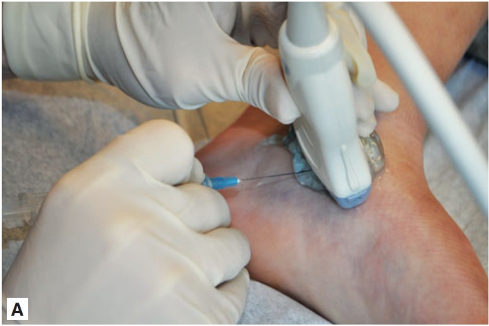 File:Talonavicular joint injection ultrasound out of plane.jpg