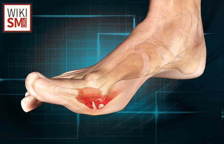 File:Turf toe illustration.jpeg