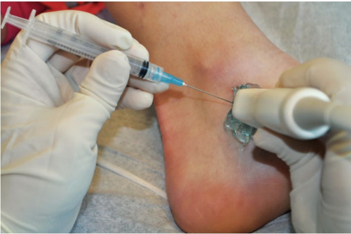 File:Talonavicular joint injection ultrasound in plane.jpg
