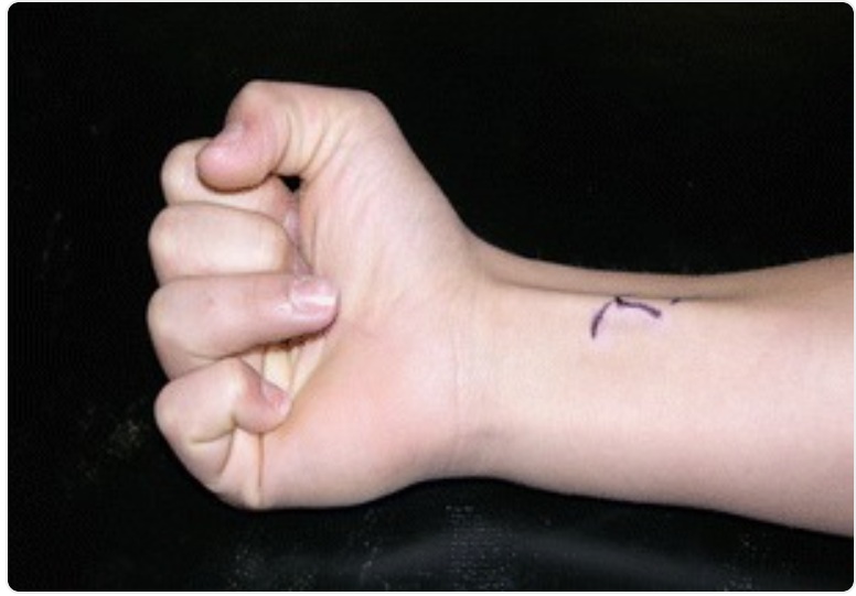 File:Jersey finger exam.jpg