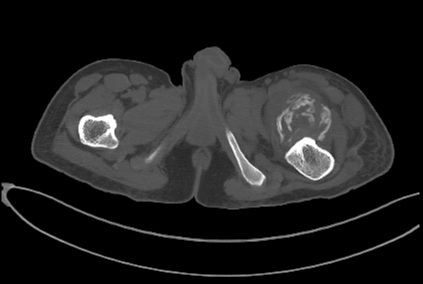 File:Myositis ossificans CT.jpg