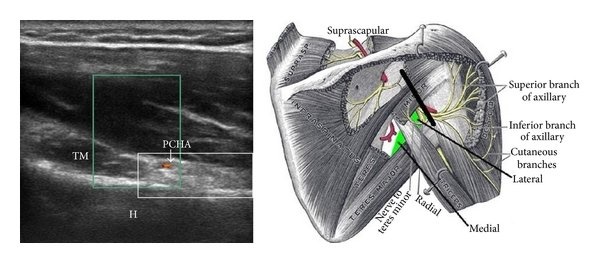 File:Ultrasound view of the quadrilateral space.jpg
