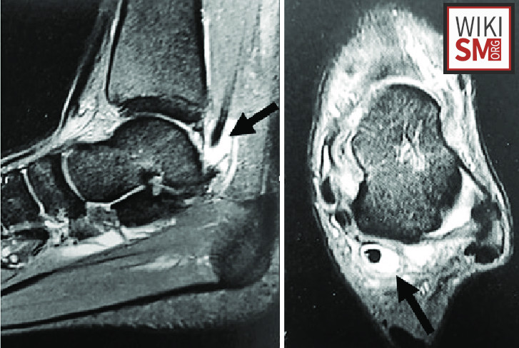 File:MRI hallux saltans trigger toe.jpeg