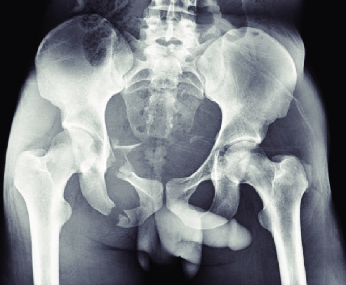 File:Pelvic fracture xray.jpg