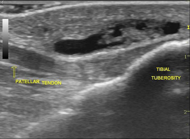File:Knee US superficial infrapatellar bursitis.jpg