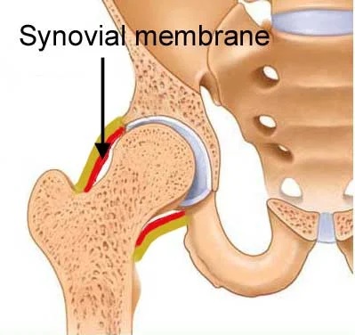 File:Hip transient synovitis.jpg