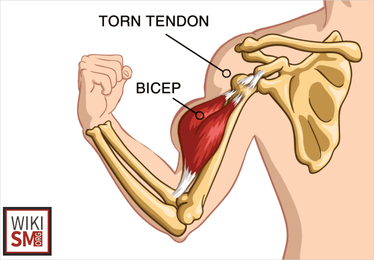 File:Illustration popeye deformity biceps.jpeg
