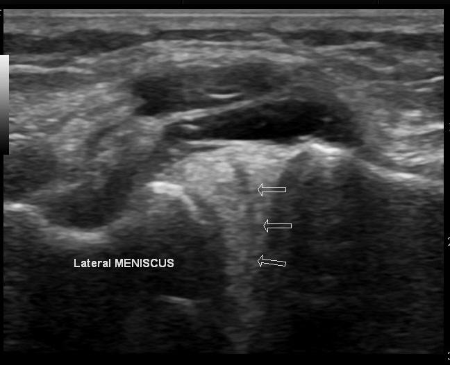 File:Knee US meniscal cyst and meniscal tear.jpg