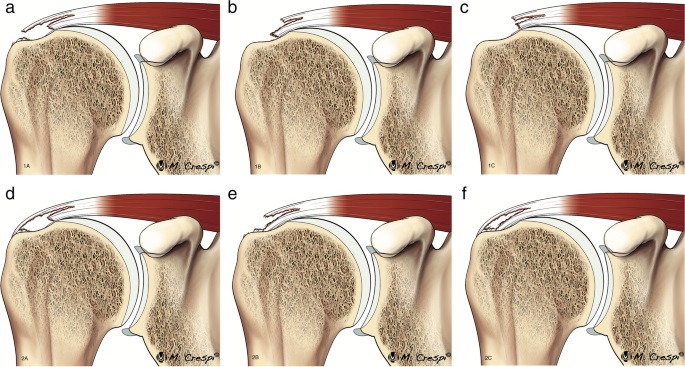 File:Patterns of rotator cuff tears.jpg