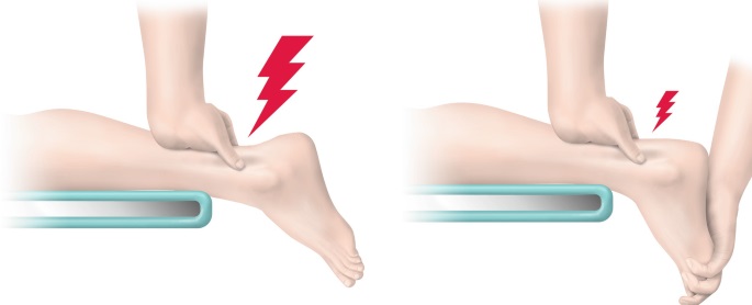 File:The arc sign achilles tendonitis.jpg