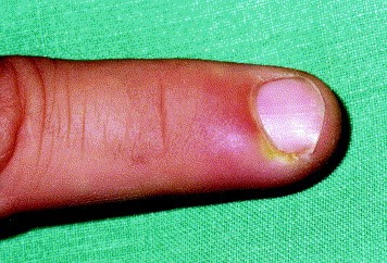 File:Paronychia Digital Pressure Test.jpg