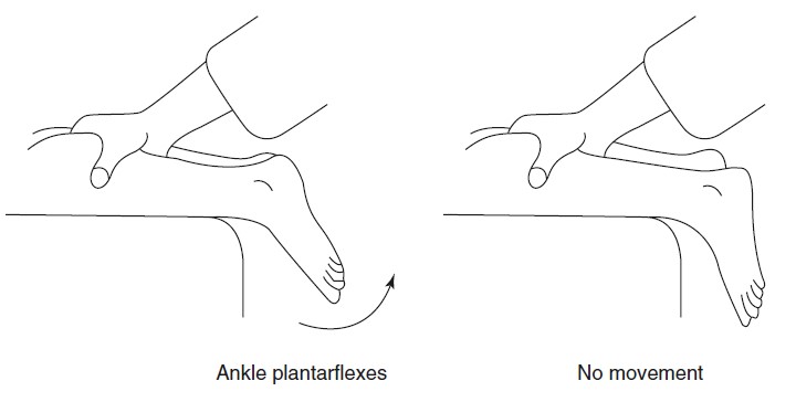 File:Calf squeeze test achilles tendon.jpg