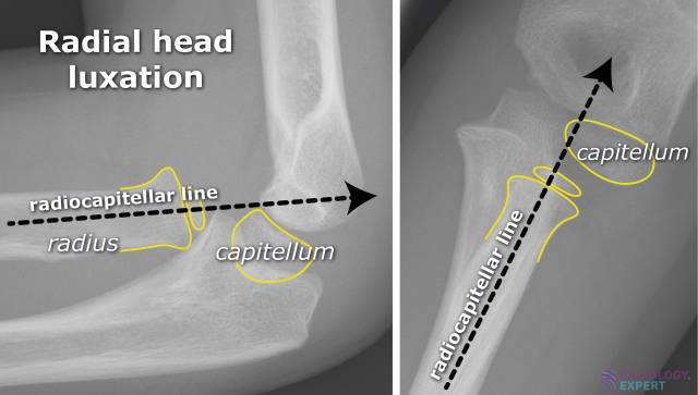 File:Elbow XR abnormal radiocapitellar line with illustration.jpg