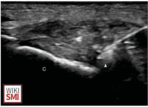 File:Achilles tendon injection insertional long axis in plane US.jpg