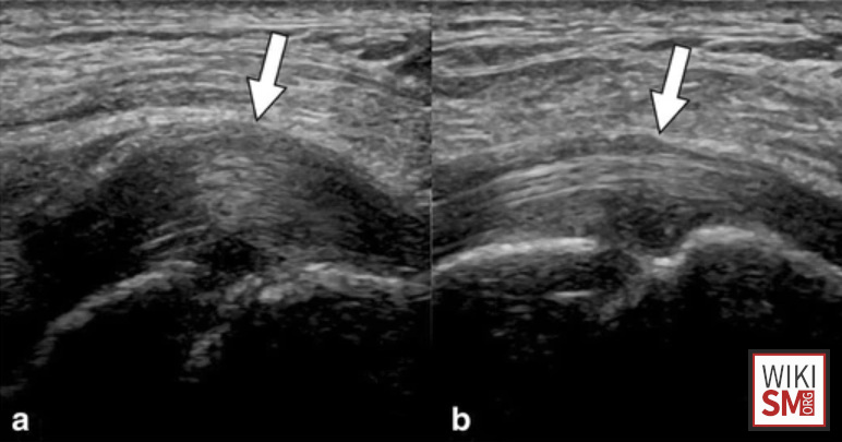File:Trigger toe ultrasound.jpeg