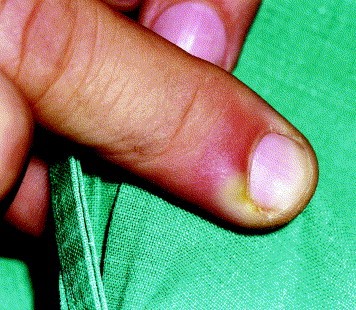 File:Paronychia Digital Pressure Test 2.jpg