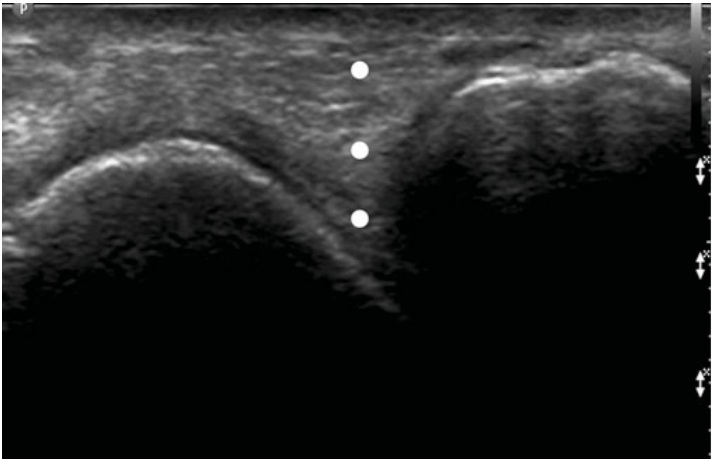 File:Talonavicular joint injection ultrasound 2.jpg