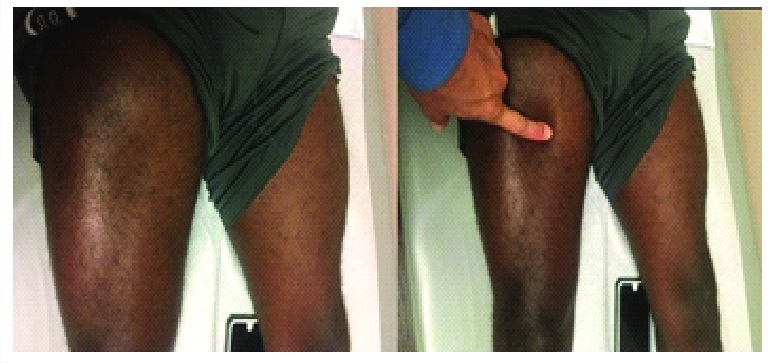 File:Rectus femoris tear clinical.jpg