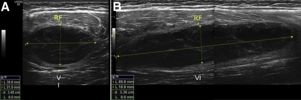 File:Thigh ultrasound quadriceps hematoma in long and short axis.jpg