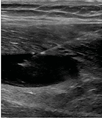 File:Thigh uultrasound hematoma aspiration with needle in plane.jpg
