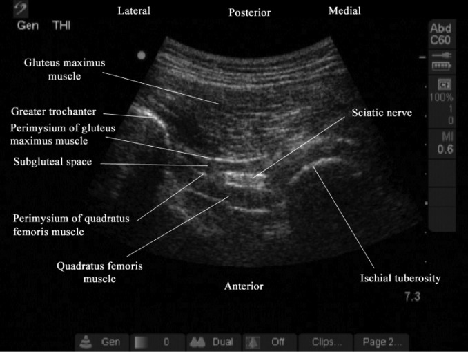 File:Hip ultrasound sciatic nerve block with labels.jpg
