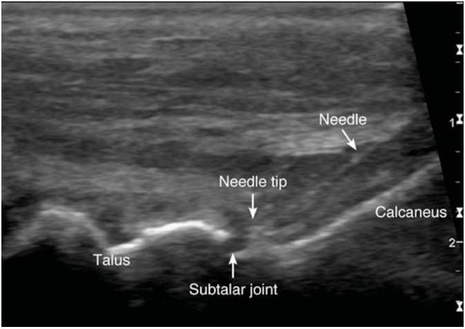 File:Subtalar joint injection ultrasound needle.jpg
