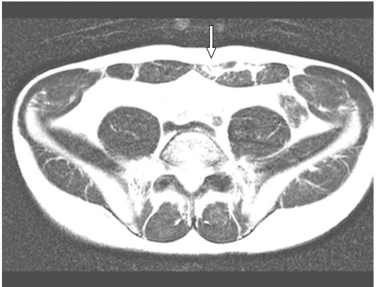 File:MRI rectus abdominis strain.jpg