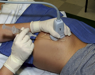File:Probe and needle position for piriformis injection.jpg