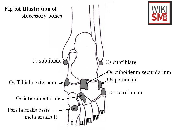 File:Accessory bones foot ankle.jpeg