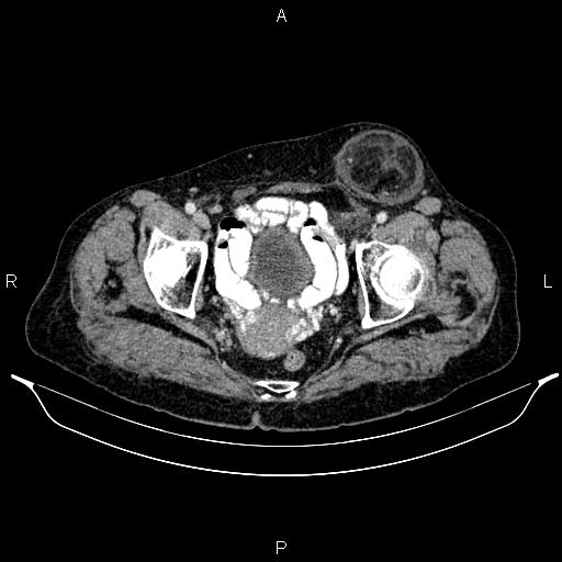File:CT femoral hernia.jpg