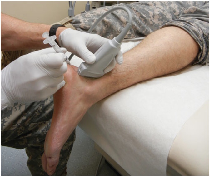 File:Subtalar joint injection needle and probe placement.jpg