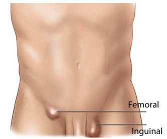 File:Inguinal femoral hernia clinical.jpg