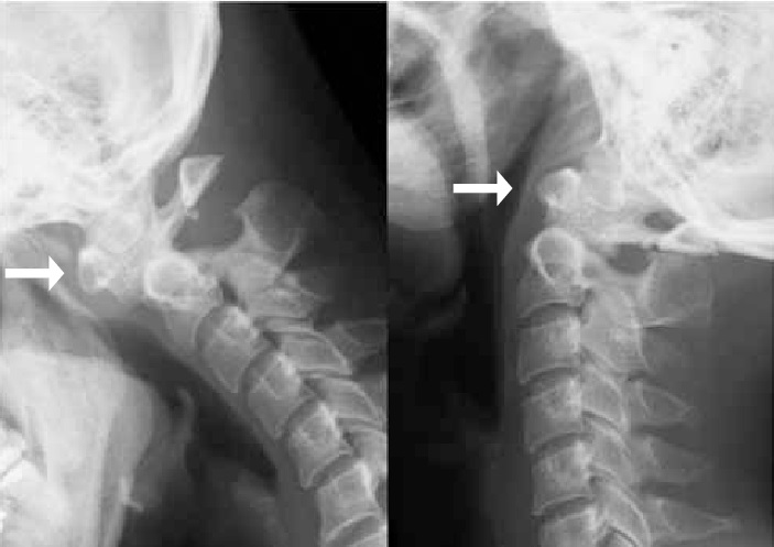 File:Xray os odontoideum.jpg