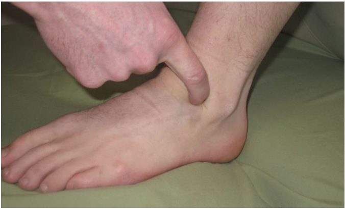 File:Sinus tarsi clinical.jpg