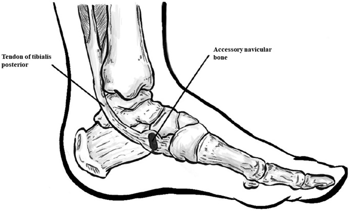 File:Illustration of accessory navicular.png