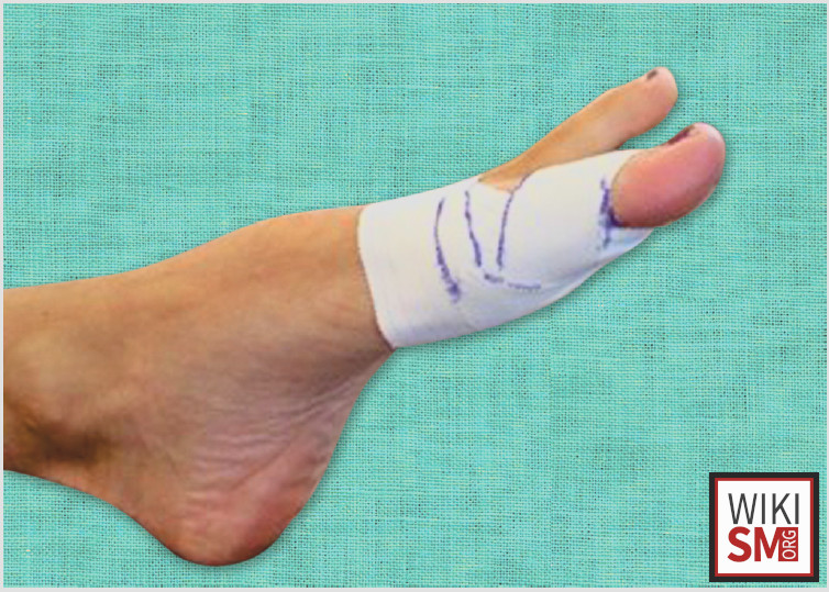 File:Toe spica taping.jpeg