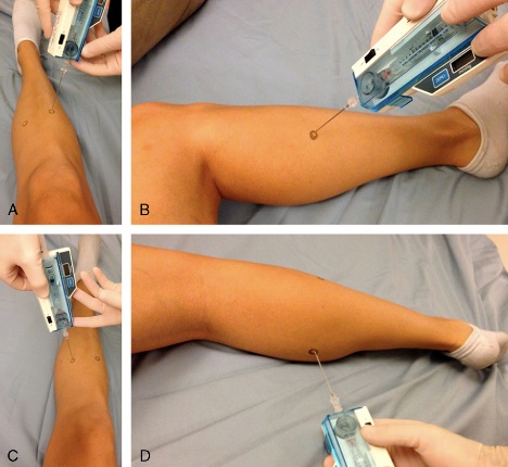 File:Demonstration of compartment pressure measurement compartment syndrome.jpg