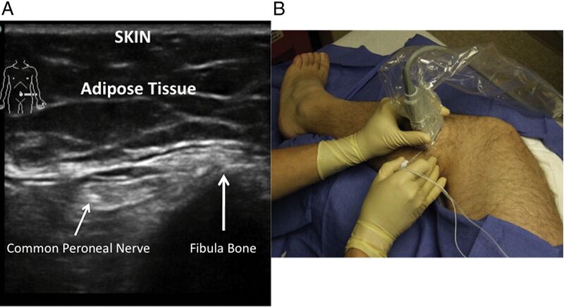 File:Common Peroneal Nerve Block.jpg